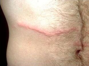 Comment se débarrasser des parasites sous-cutanés chez l'homme
