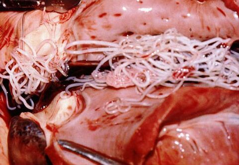 Parasites dans le corps humain